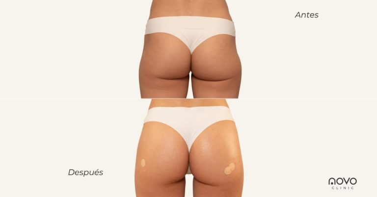 armonizacion-gluteos-antes-despues